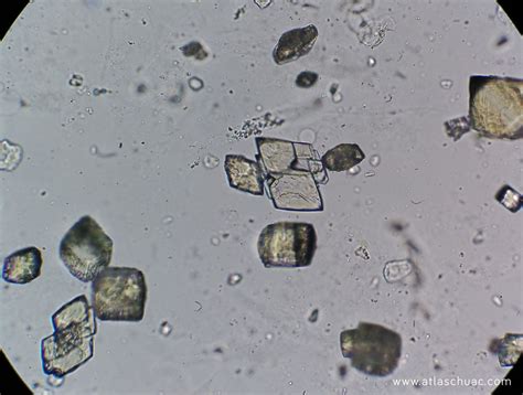 cristales de Ácido urico en sedimento urinario sedimento acidourico