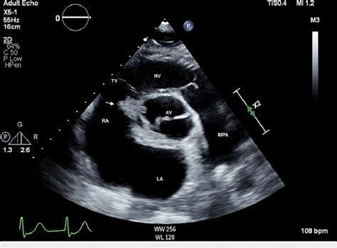 Transthoracic Echocardiogram Parasternal Short Axis View Demonstrates Download Scientific