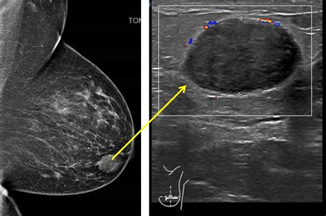 Phyllodes Tumor Growth Rate