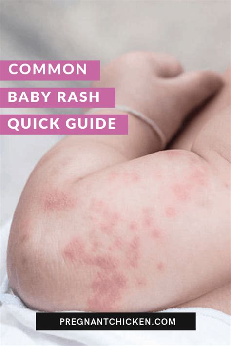 Types Of Baby Rashes Baby Rash Rashes Remedies Diaper Rash Remedy