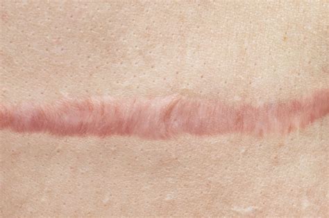 Botulinum Toxin Type A Effective For Treatment Of Hypertrophic Scars Dermatology Advisor
