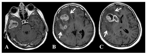 Reducing carbs and replacing them with healthy fats can cause your body to enter a metabolic state known as ketosis. Metabolic management of glioblastoma multiforme using