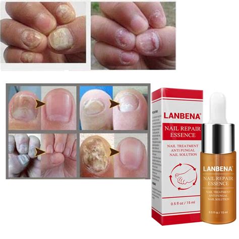 Lanbena Hands And Feet Care Nail Fungus Repair Essence Serum Fungal