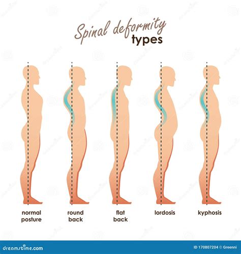 Diseases Of The Spine Scoliosis Lordosis Swayback Slouch Body Posture