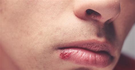 Opryszczka na ustach przyczyny objawy leczenie Maści na opryszczkę