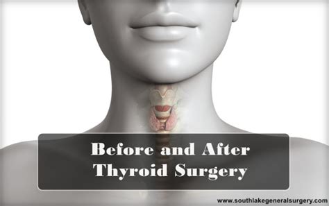 Before And After Thyroid Surgery Dr Valeria Simone Southlake General