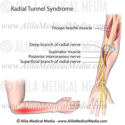 Radial Tunnel Syndrome Alila Medical Images