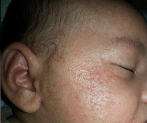 Rough Bumps On Face Dorothee Padraig South West Skin Health Care
