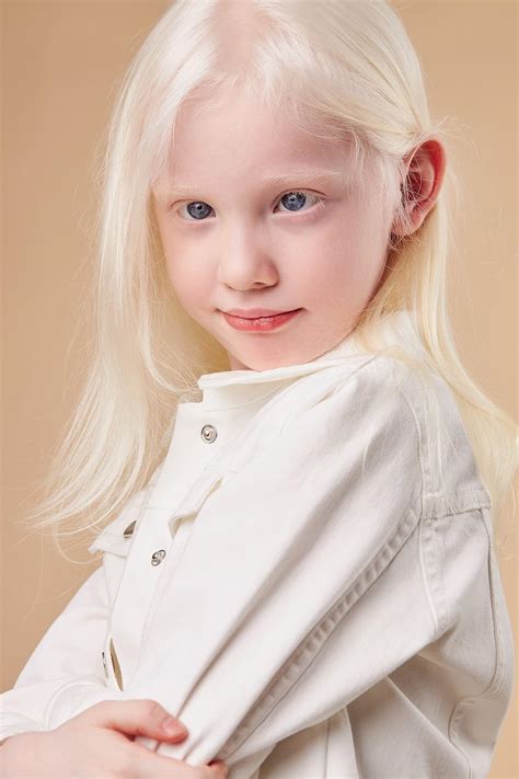 Albinizm przyczyny objawy skutki Czy bielactwo wrodzone można leczyć