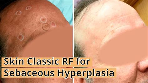 Sebaceous Hyperplasia Before And After