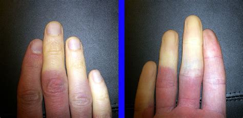 Raynauds Disease Causes Symptoms And Treatment Lecturio