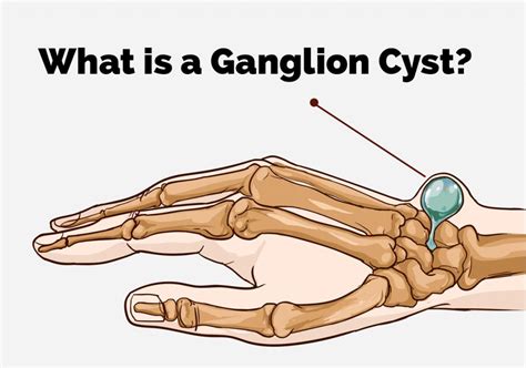 What Is A Ganglion Cyst Excision With Pictures Images And Photos Finder