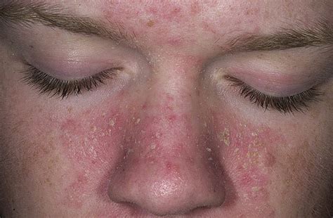 Exposed Seborrhea Dermatitis And Seborrhea Conditions Treatment For Seborrheic Dermatitis