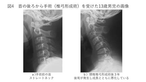 首の骨のカーブ あるべき自然な形 その1｜白石脊椎クリニック