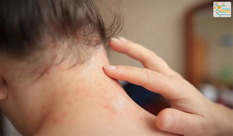 Виды сыпи Фото 47911 Аллергия на шее может сигнализировать о