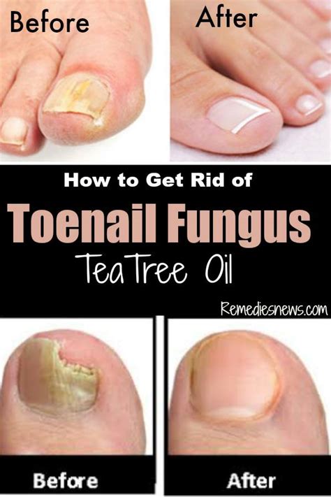 How To Get Rid Of Toenail Fungus With Tea Tree Oil Fast Remedy