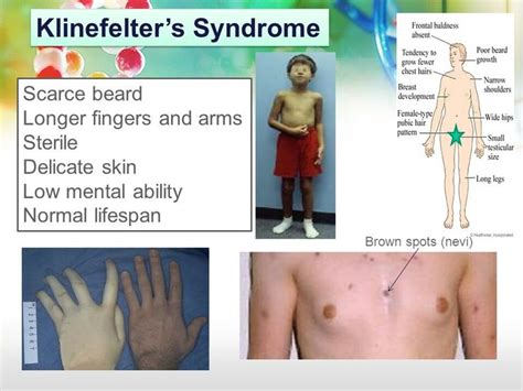 Klinefelter Syndrome Infogram Charts And Infographics Images And
