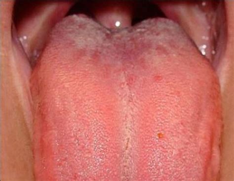 Swollen Taste Buds Inflamed Causes On Sides Tip Under