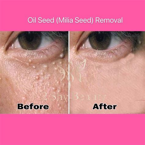 Oil Seedmilia Seedmoleskin Tag Removal Treatment Lifestyle Services