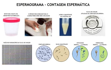 ESPERMOGRAMA Dr Eduardo Dale Ginecologia e Reprodução Humana