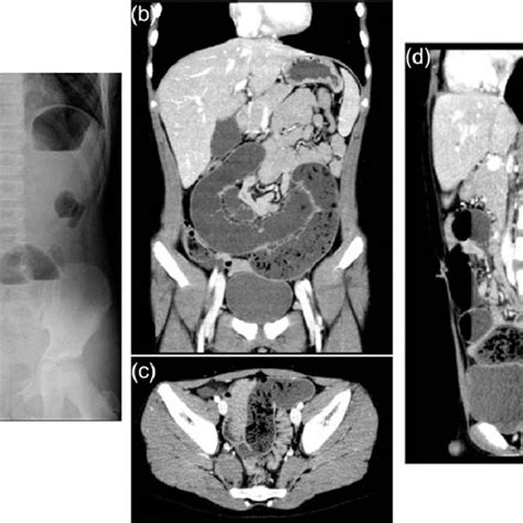 Abdominal X Ray And Enhanced Computed Tomography A Abdominal X Ray