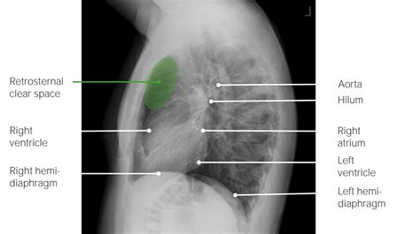 Lateral Chest Radiograph Anatomy