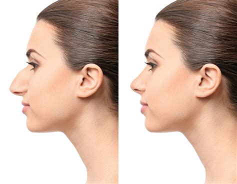 Five Things You Need To Know About Rhinoplasty Women Daily Magazine