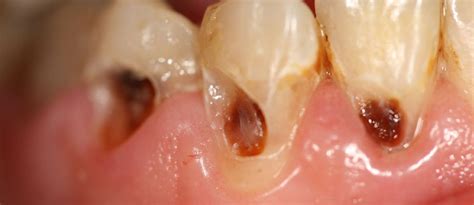 Dental caries may be classified according to the severity and rapidity of attack infancy caries in children with infancy caries, there is a unique distribution of dental decay. G.V. Black's Classification of Carious Lesions / Caries ...