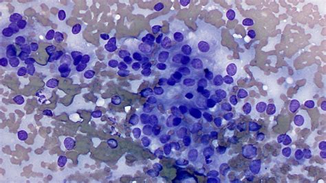 Epithelial Tumors Eclinpath