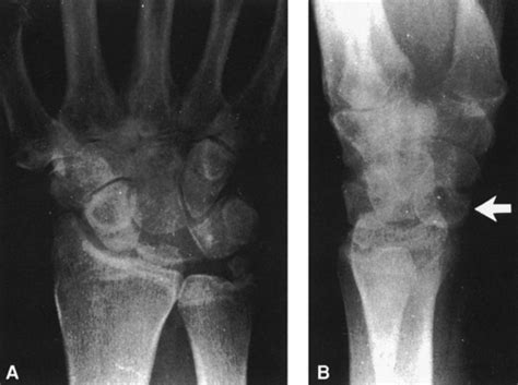 Traumatic Lesions of Bones and Joints | Radiology Key