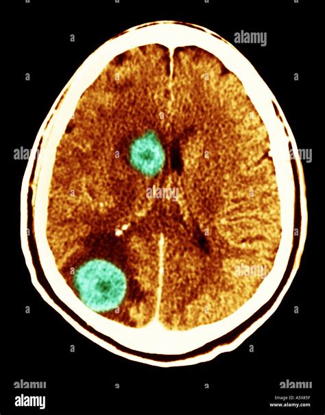 Mri Scan Of The Brain Showing Metastatic Tumors Computer Enhanced Image