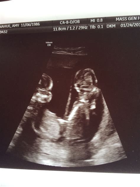 Mum And Babies 16 Weeks Pregnant Ultrasound
