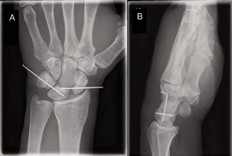 Compound Transstyloid Transscaphoid Perilunate Fracture Dislocation Ali N Bhat Sa Mahajan A