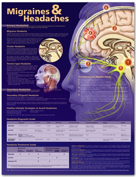 Migraines And Headaches Poster Migraine Anatomical Chart Company