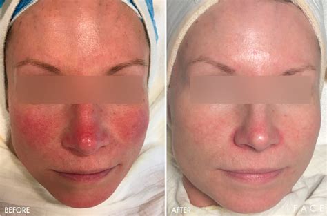 Face Photo Gallery Rednessrosacea Face Beauty Science