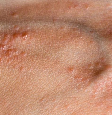 Breaking Out In Red Itchy Bumps Causes And Cures Of Rashes Parents