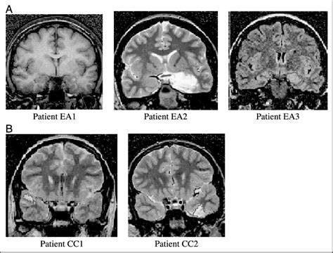 Selected Mr Images Of Patients In The Early Amygdala Damage And