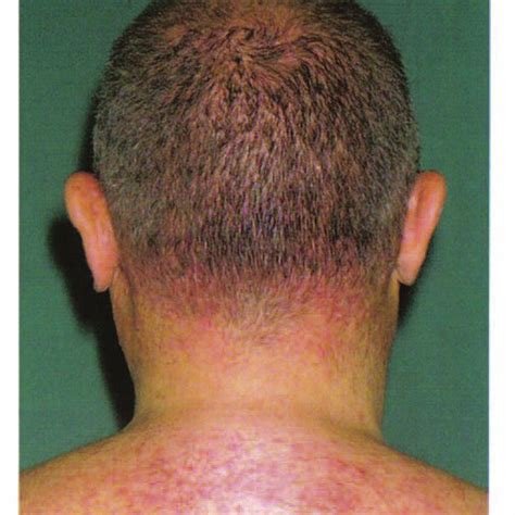 Pdf Erlotinib Induced Skin Rash Spares Skin In Previous Radiotherapy