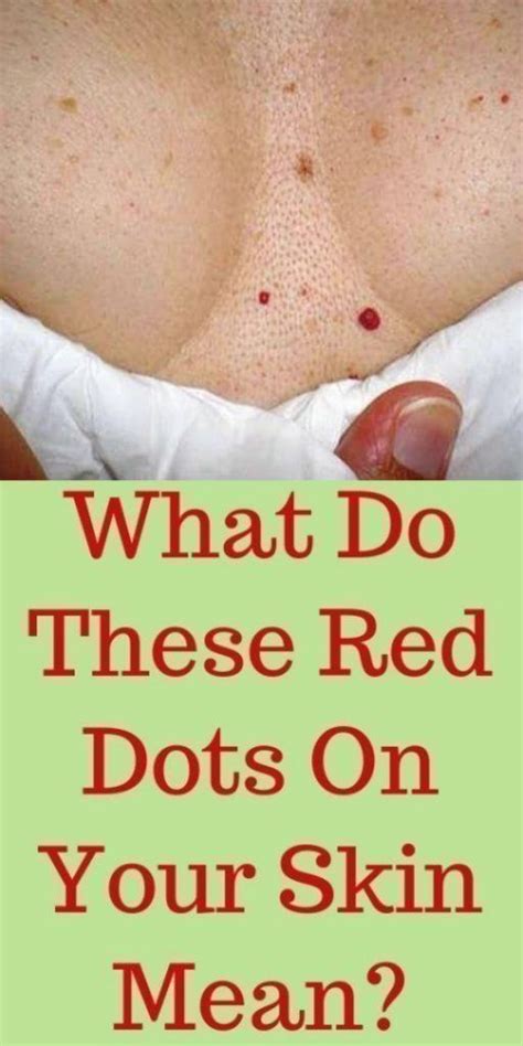 Do You Have These Red Spots On Various Parts Of Your Body Should You Worry What Should You Do