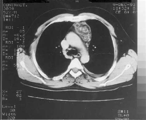 A Ct Scan Of The Chest Showing Intrathymic Parathyroid Adenoma