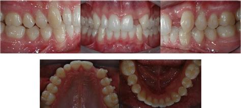 Post Orthodontic Treatment Records Before Restorative Treatment A To E