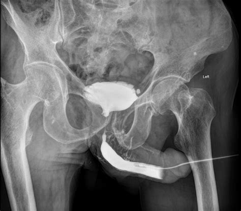 Venous Intravasation In Retrograde Urethrography Image Radiopaedia Org