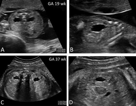 Ultrasound Appearance Of Utd A1 A And B Fetal Kidneys At 19 Weeks