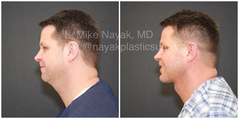 Buccal Fat Removal Before And After Patient 03 Nayak Plastic Surgery