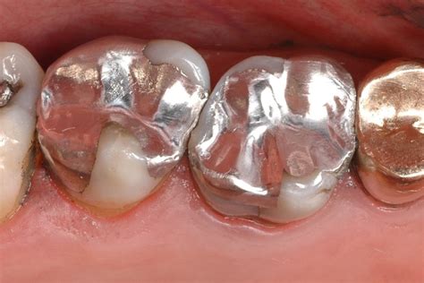 It contains a mixture of metals such as silver, copper and tin, in addition to mercury, which binds these components into a hard, stable and safe substance. ADA NSW - Complex Amalgam Restorations and Update on Amalgam