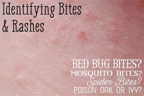 Mosquito Bed Bug Spider Bite Comparison Healdove