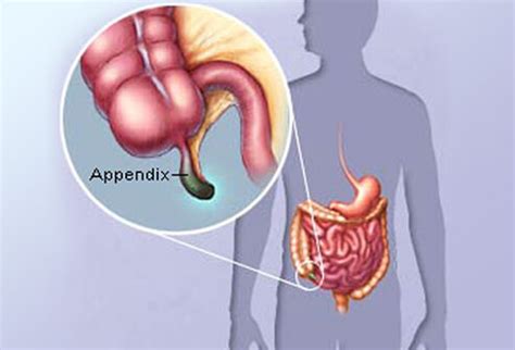 In addition to following basic apa formatting rules, you should also check to see if there are additional guidelines you need to follow. Appendicitis definition and facts | Matthew Johnson MD, FACS