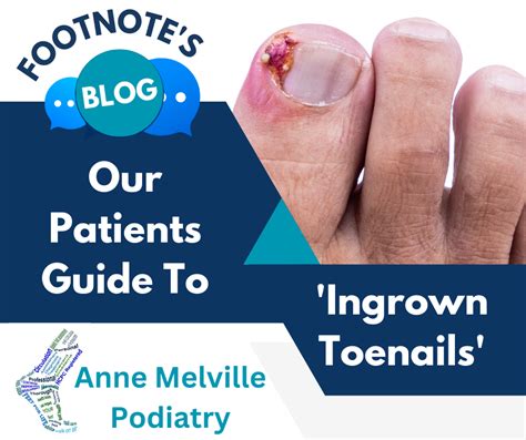 Patients Guide To Ingrown Toenails