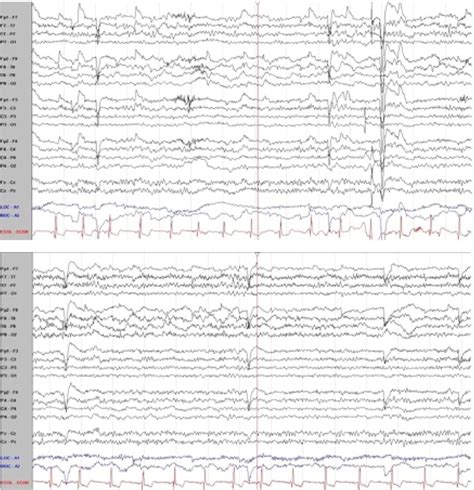Intra Operative Eeg Findings Continuous Eeg Tracings Demonstrating