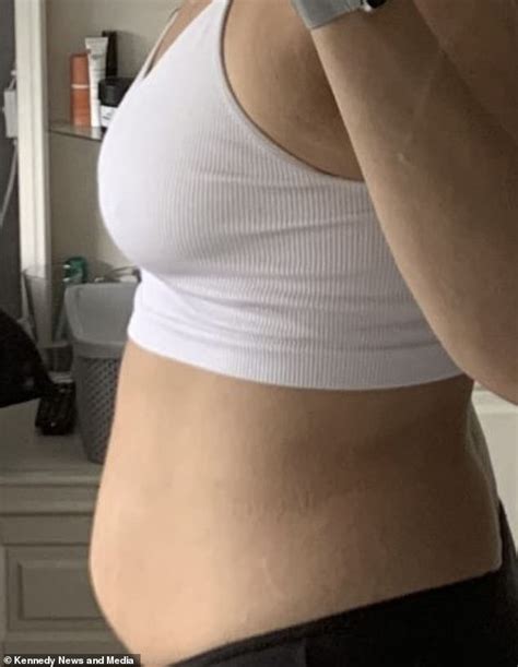 Woman Says Giant Ovarian Cyst Made Her Look Like She Was Pregnant The Projects World